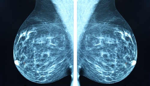 Quimioterapia pode ser evitada em 70% das mulheres com câncer de mama