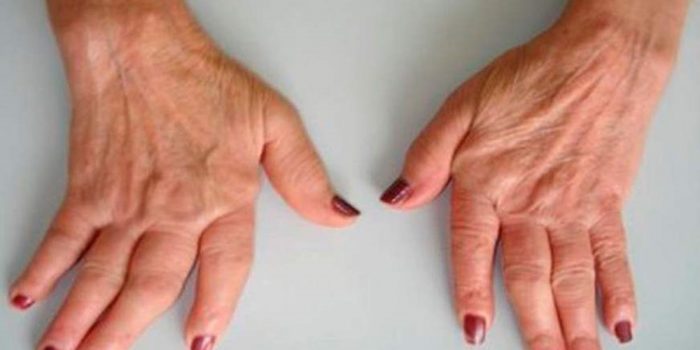 Pesquisa revela impactos da  artrite reumatoide em pacientes