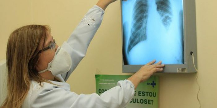 Governo cria comitê para eliminar a tuberculose